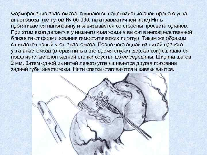 Формирование анастомоза: сшиваются подслизистые слои правого угла анастомоза. (кетгутом № 00 -000, на атравматичной