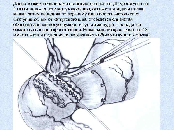 Далее тонкими ножницами вскрывается просвет ДПК, отступив на 2 мм от наложенного кетгутового шва,