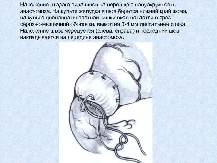 Наложение второго ряда швов на переднюю полуокружность анастомоза. На культе желудка в шов берется