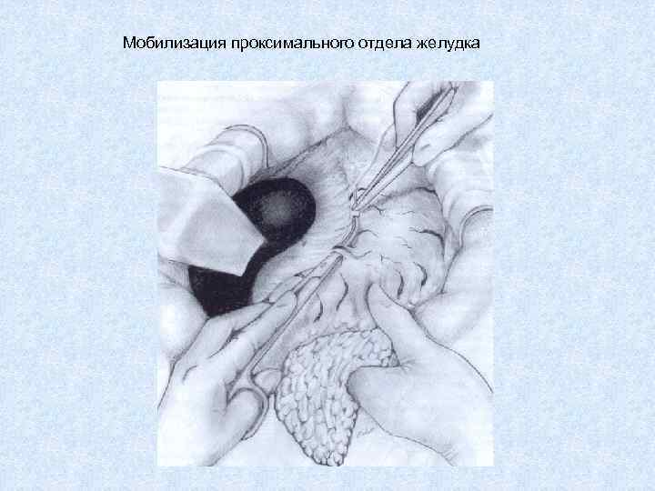 Мобилизация проксимального отдела желудка 