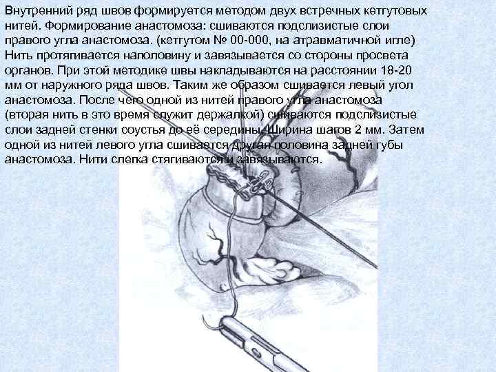 Внутренний ряд швов формируется методом двух встречных кетгутовых нитей. Формирование анастомоза: сшиваются подслизистые слои