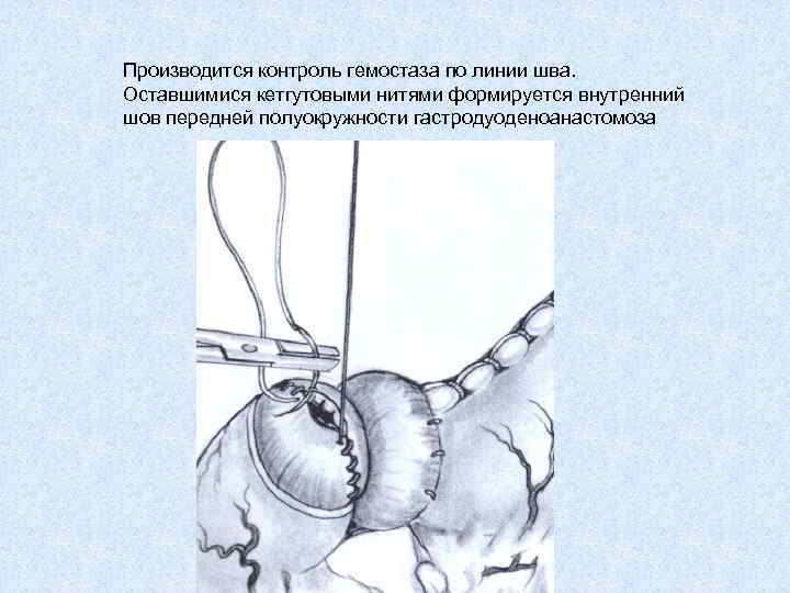 Производится контроль гемостаза по линии шва. Оставшимися кетгутовыми нитями формируется внутренний шов передней полуокружности