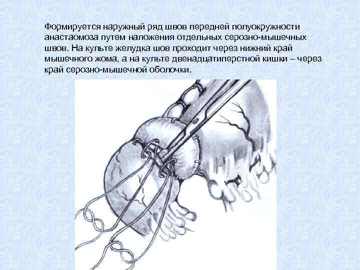 Формируется наружный ряд швов передней полуокружности анастаомоза путем наложения отдельных серозно-мышечных швов. На культе