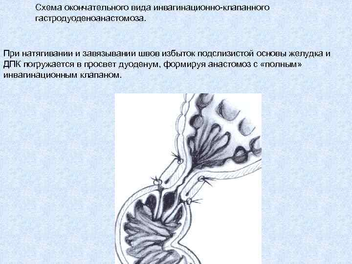 Схема окончательного вида инвагинационно-клапанного гастродуоденоанастомоза. При натягивании и завязывании швов избыток подслизистой основы желудка