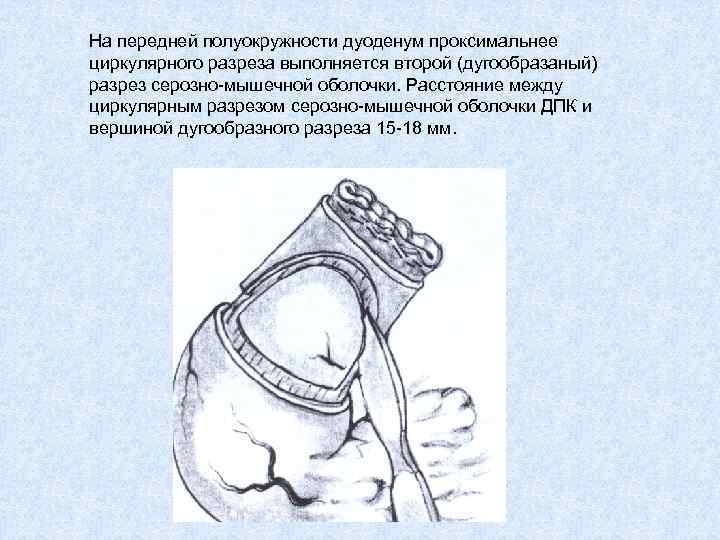 На передней полуокружности дуоденум проксимальнее циркулярного разреза выполняется второй (дугообразаный) разрез серозно-мышечной оболочки. Расстояние