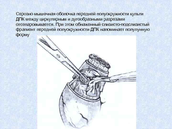 Серозно мышечная оболочка передней полуокружности культи ДПК между циркулярным и дугообразными разрезами отсепаровывается. При