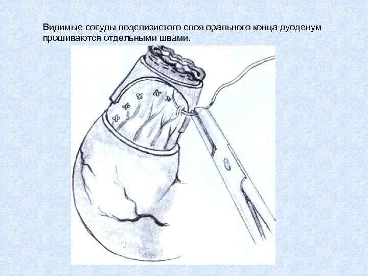 Видимые сосуды подслизистого слоя орального конца дуоденум прошиваются отдельными швами. 