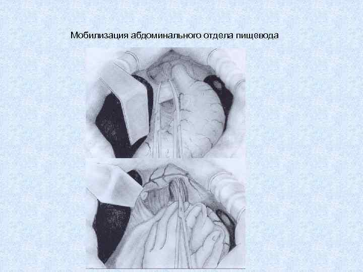 Мобилизация абдоминального отдела пищевода 