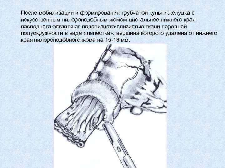 После мобилизации и формирования трубчатой культи желудка с искусственным пилороподобным жомом дистальнее нижнего края