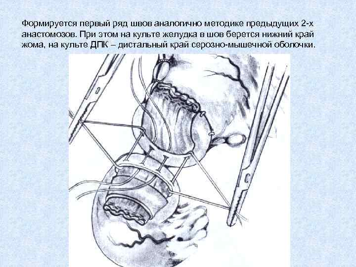 Формируется первый ряд швов аналогично методике предыдущих 2 -х анастомозов. При этом на культе