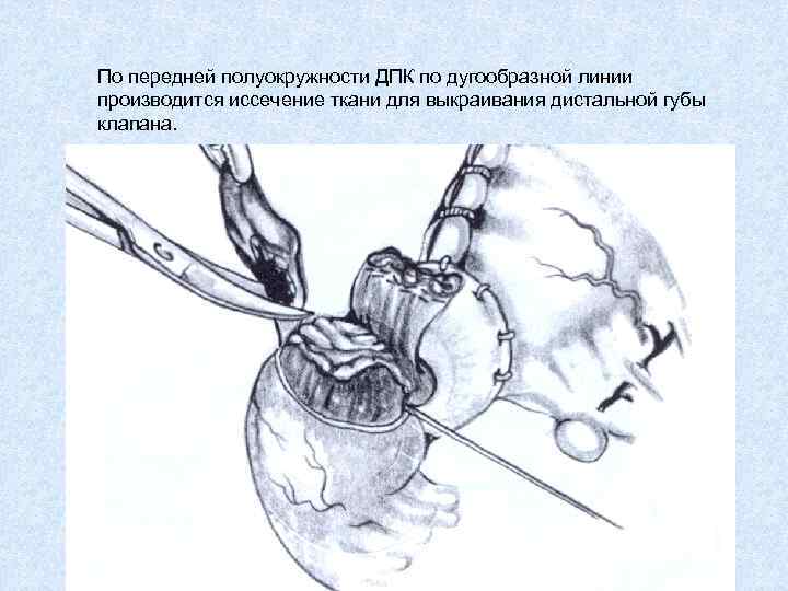 По передней полуокружности ДПК по дугообразной линии производится иссечение ткани для выкраивания дистальной губы