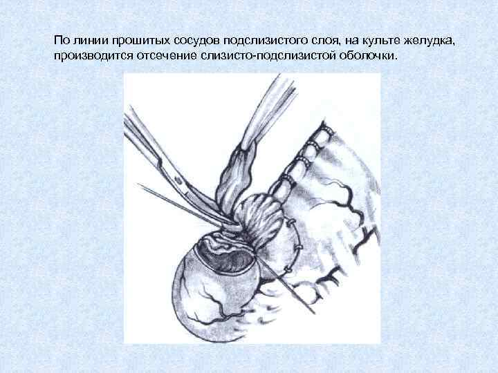 По линии прошитых сосудов подслизистого слоя, на культе желудка, производится отсечение слизисто-подслизистой оболочки. 