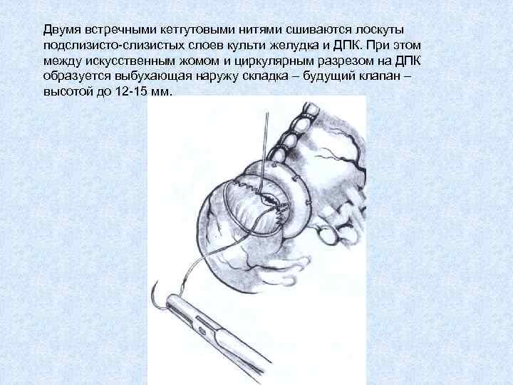 Двумя встречными кетгутовыми нитями сшиваются лоскуты подслизисто-слизистых слоев культи желудка и ДПК. При этом