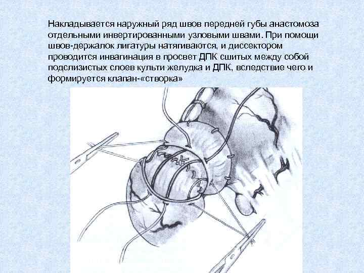 Накладывается наружный ряд швов передней губы анастомоза отдельными инвертированными узловыми швами. При помощи швов-держалок