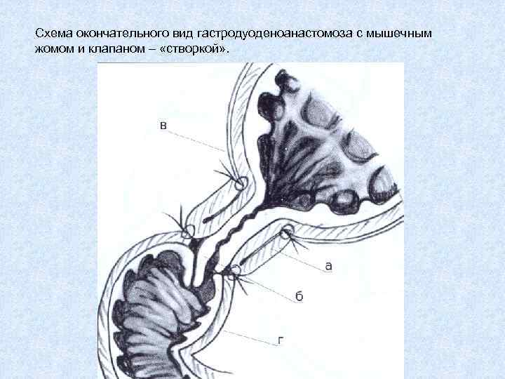 Схема окончательного вид гастродуоденоанастомоза с мышечным жомом и клапаном – «створкой» . 