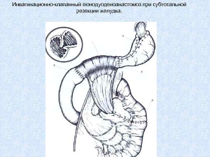 Инвагинационно-клапанный еюнодуоденоанастомоз при субтотальной резекции желудка. 