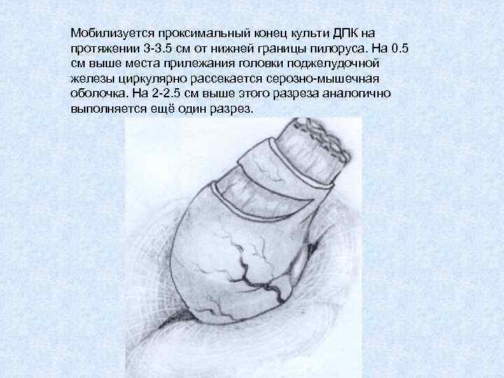 Мобилизуется проксимальный конец культи ДПК на протяжении 3 -3. 5 см от нижней границы