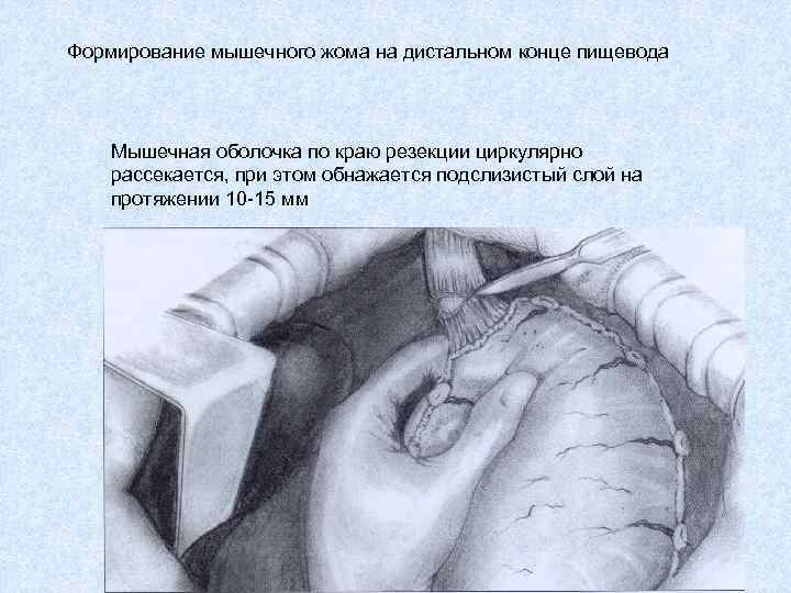 Формирование мышечного жома на дистальном конце пищевода Мышечная оболочка по краю резекции циркулярно рассекается,