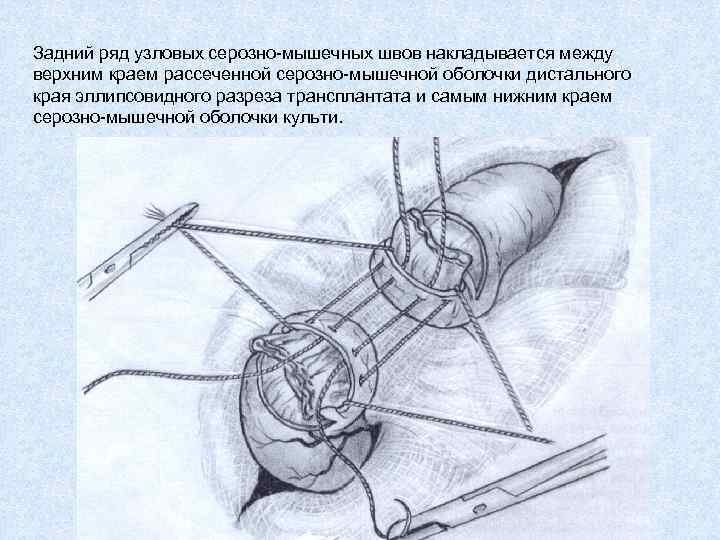Задний ряд узловых серозно-мышечных швов накладывается между верхним краем рассеченной серозно-мышечной оболочки дистального края