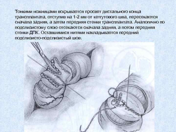 Тонкими ножницами вскрывается просвет дистального конца трансплантата, отступив на 1 -2 мм от кетгутового
