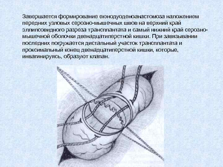 Завершается формирование еюнодуоденоанастомоза наложением передних узловых серозно-мышечных швов на верхний край эллипсовидного разреза трансплантата