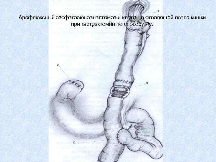 Арефлюксный эзофагоеюноанастомоз и клапан в отводящей петле кишки при гастрэктомии по способу Ру. 