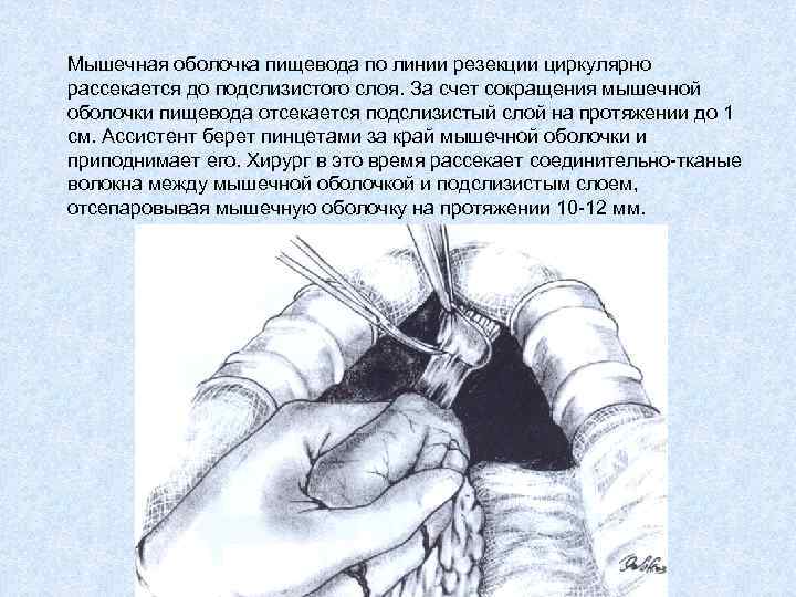 Мышечная оболочка пищевода по линии резекции циркулярно рассекается до подслизистого слоя. За счет сокращения