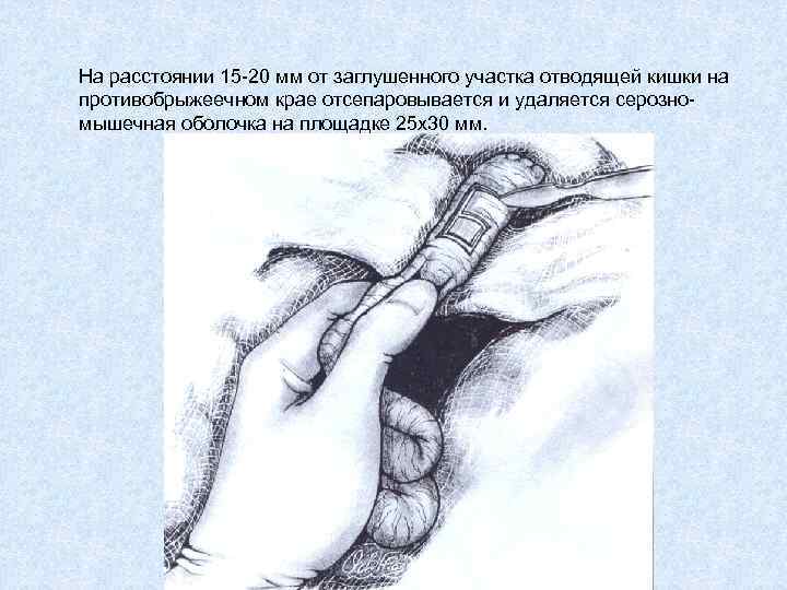 На расстоянии 15 -20 мм от заглушенного участка отводящей кишки на противобрыжеечном крае отсепаровывается