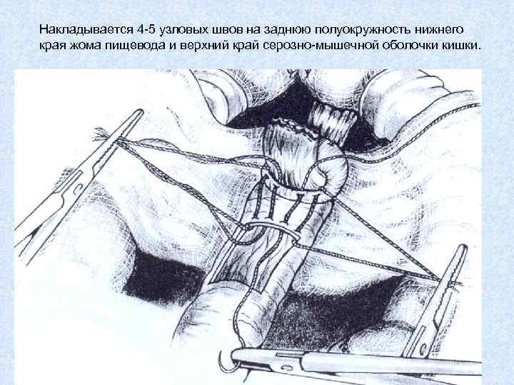 Накладывается 4 -5 узловых швов на заднюю полуокружность нижнего края жома пищевода и верхний