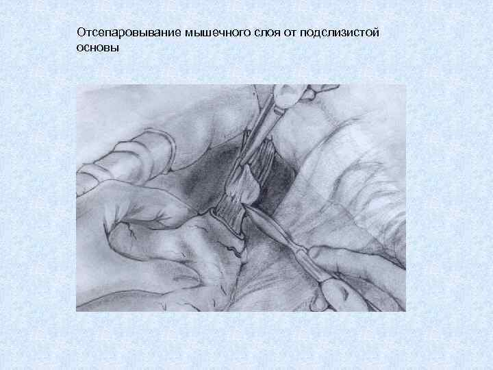 Отсепаровывание мышечного слоя от подслизистой основы 