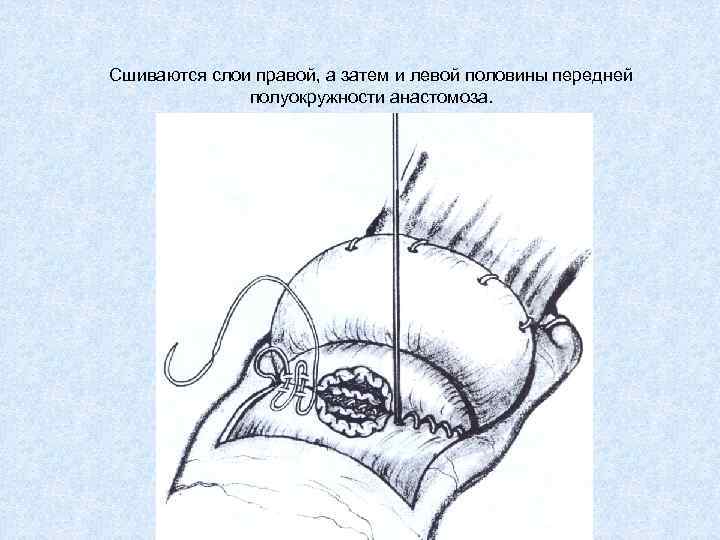 Сшиваются слои правой, а затем и левой половины передней полуокружности анастомоза. 