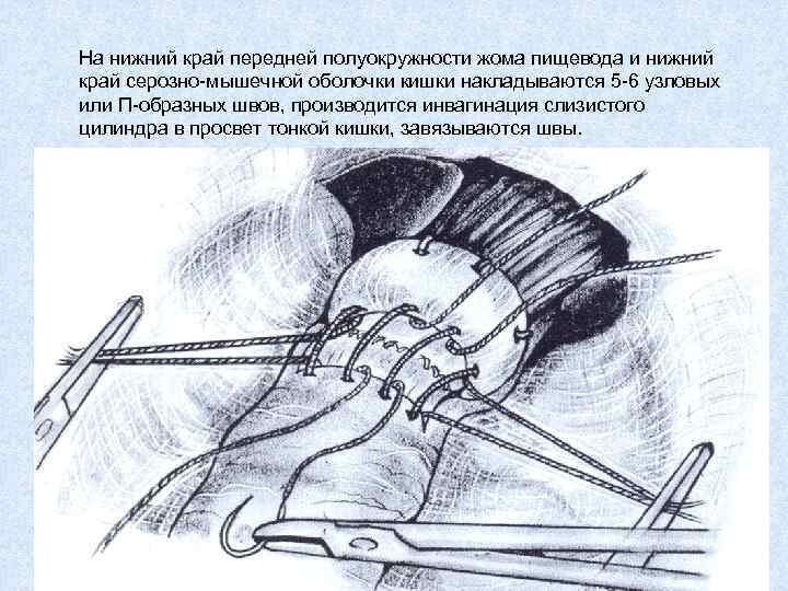 На нижний край передней полуокружности жома пищевода и нижний край серозно-мышечной оболочки кишки накладываются