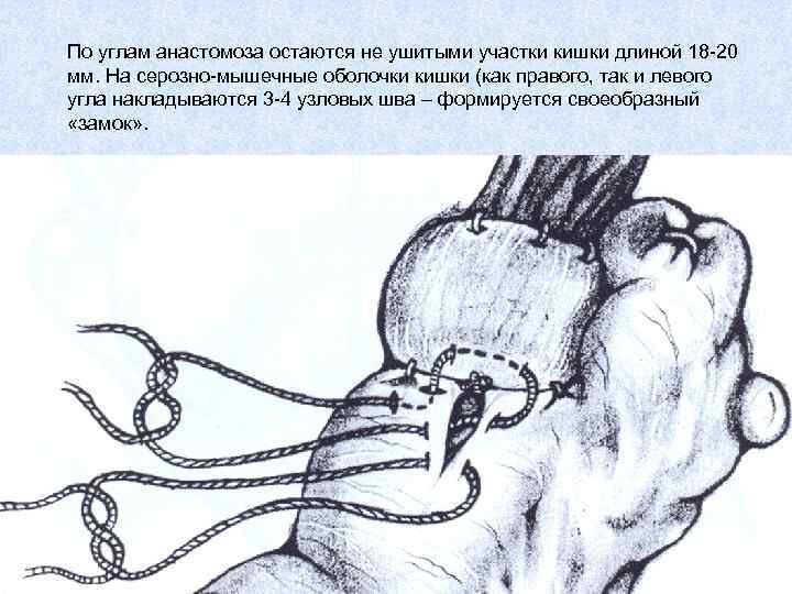 По углам анастомоза остаются не ушитыми участки кишки длиной 18 -20 мм. На серозно-мышечные