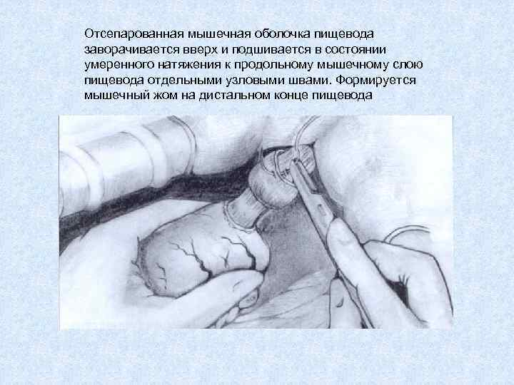 Отсепарованная мышечная оболочка пищевода заворачивается вверх и подшивается в состоянии умеренного натяжения к продольному