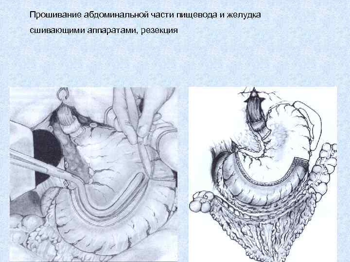 Прошивание абдоминальной части пищевода и желудка сшивающими аппаратами, резекция 