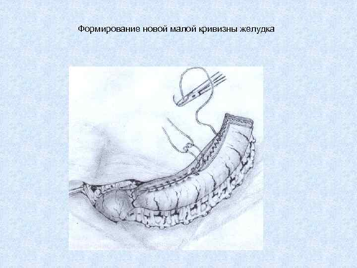 Формирование новой малой кривизны желудка 