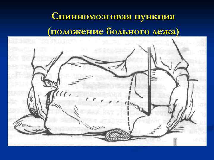 Спинномозговая пункция (положение больного лежа) 