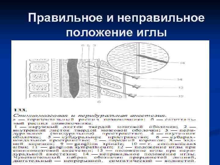 Правильное и неправильное положение иглы 