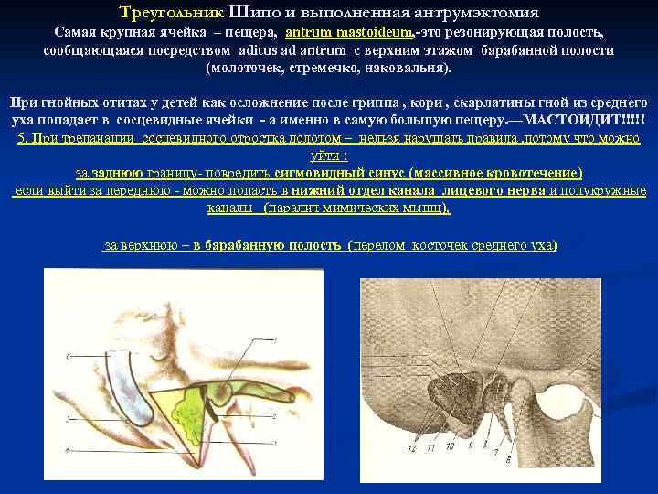 Треугольник Шипо и выполненная антрумэктомия Самая крупная ячейка – пещера, antrum mastoideum, -это резонирующая