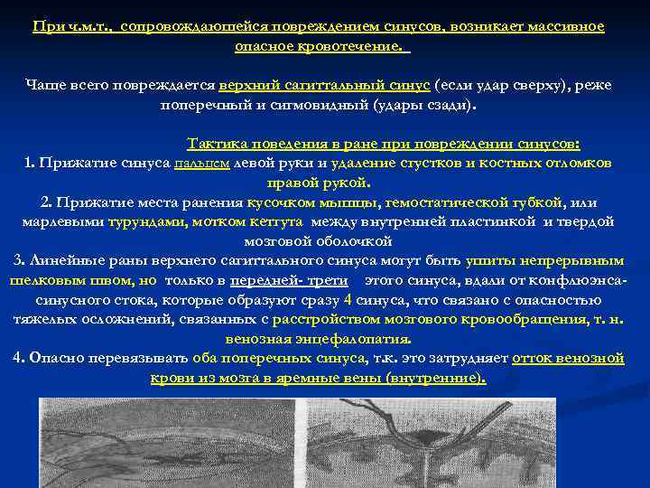 При ч. м. т. , сопровождающейся повреждением синусов, возникает массивное опасное кровотечение. Чаще всего