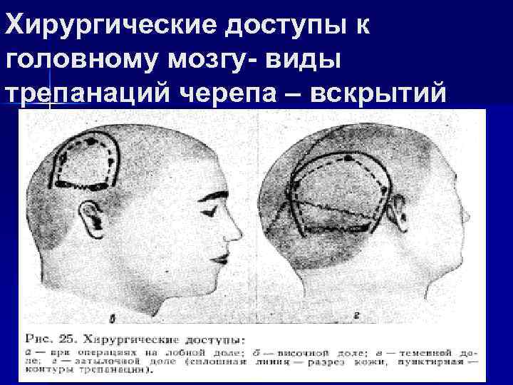 Хирургические доступы к головному мозгу- виды трепанаций черепа – вскрытий 