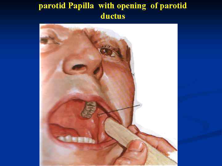 parotid Papilla with opening of parotid ductus 