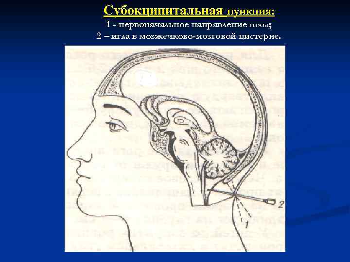 Субокципитальная пункция: 1 - первоначальное направление иглы; 2 – игла в мозжечково-мозговой цистерне. 