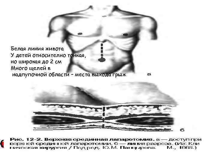 Грыжа белой линии живота у детей. Грыжа белой линии живота анатомия. Грыжа белой линии надпупочная. УЗИ белой линии живота. Грыжа белой линии живота на УЗИ.