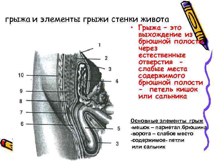 грыжа и элементы грыжи стенки живота • Грыжа – это выхождение из брюшной полости