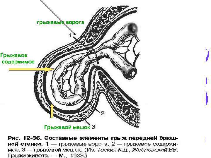 грыжевые ворота Грыжевое содержимое Грыжевой мешок 