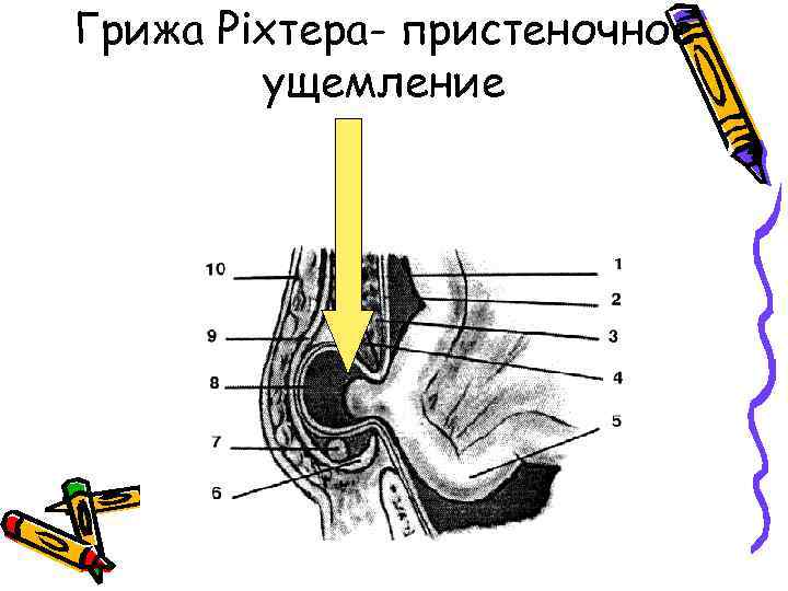 Грижа Ріхтера- пристеночное ущемление 