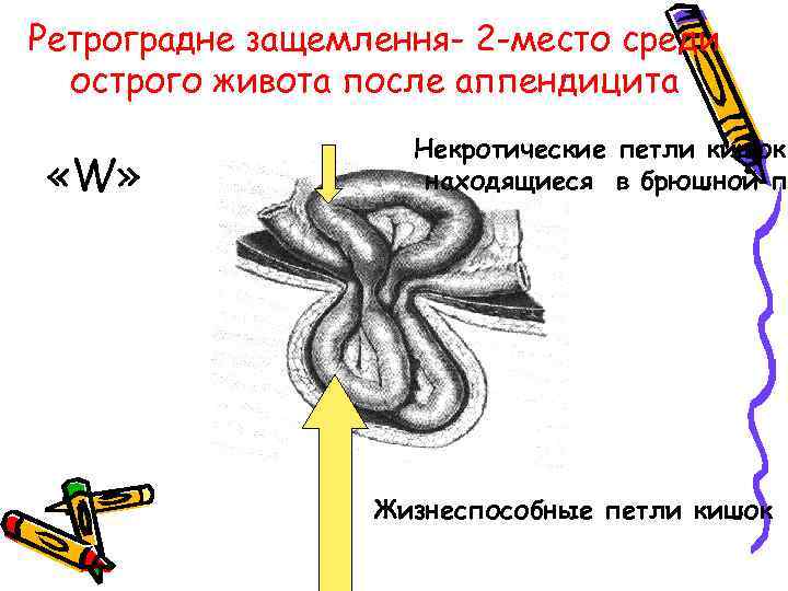 Ретроградне защемлення- 2 -место среди острого живота после аппендицита «W» Некротические петли кишок, находящиеся