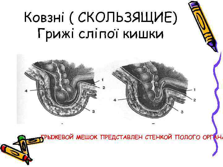 Ковзні ( СКОЛЬЗЯЩИЕ) Грижі сліпої кишки ГРЫЖЕВОЙ МЕШОК ПРЕДСТАВЛЕН СТЕНКОЙ ПОЛОГО ОРГАНА 