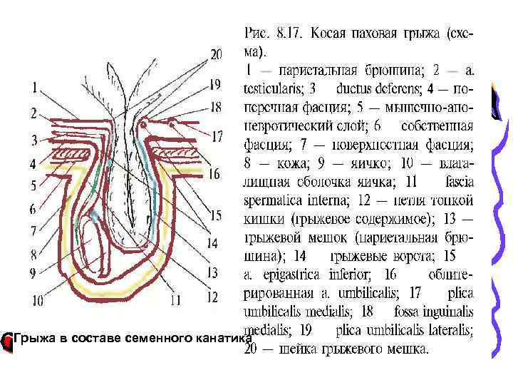 Грыжа в составе семенного канатика 